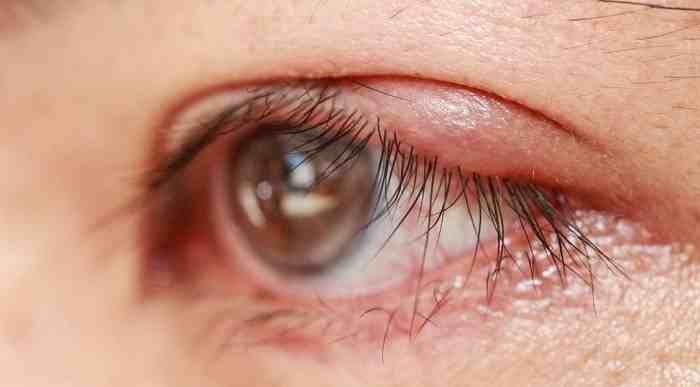 درمان بلفاریت چشم (التهاب پلک) با دارو، پماد چشمی و کمپرس گرم