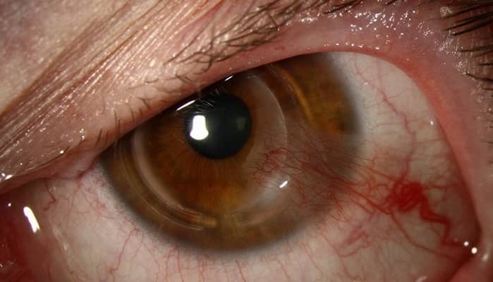 رینگ چشم چیست؟ رینگ چشم برای درمان قوز قرنیه و نزدیک بینی