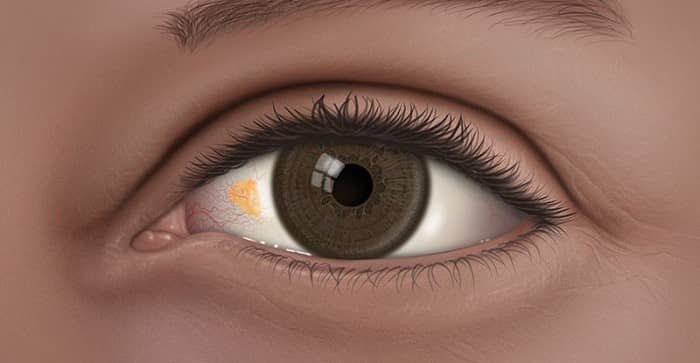 پینگوکولا قابل درمان است؟ علت ایجاد توده زرد روی چشم چیست؟