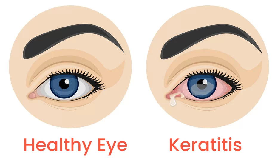 التهاب قرنیه