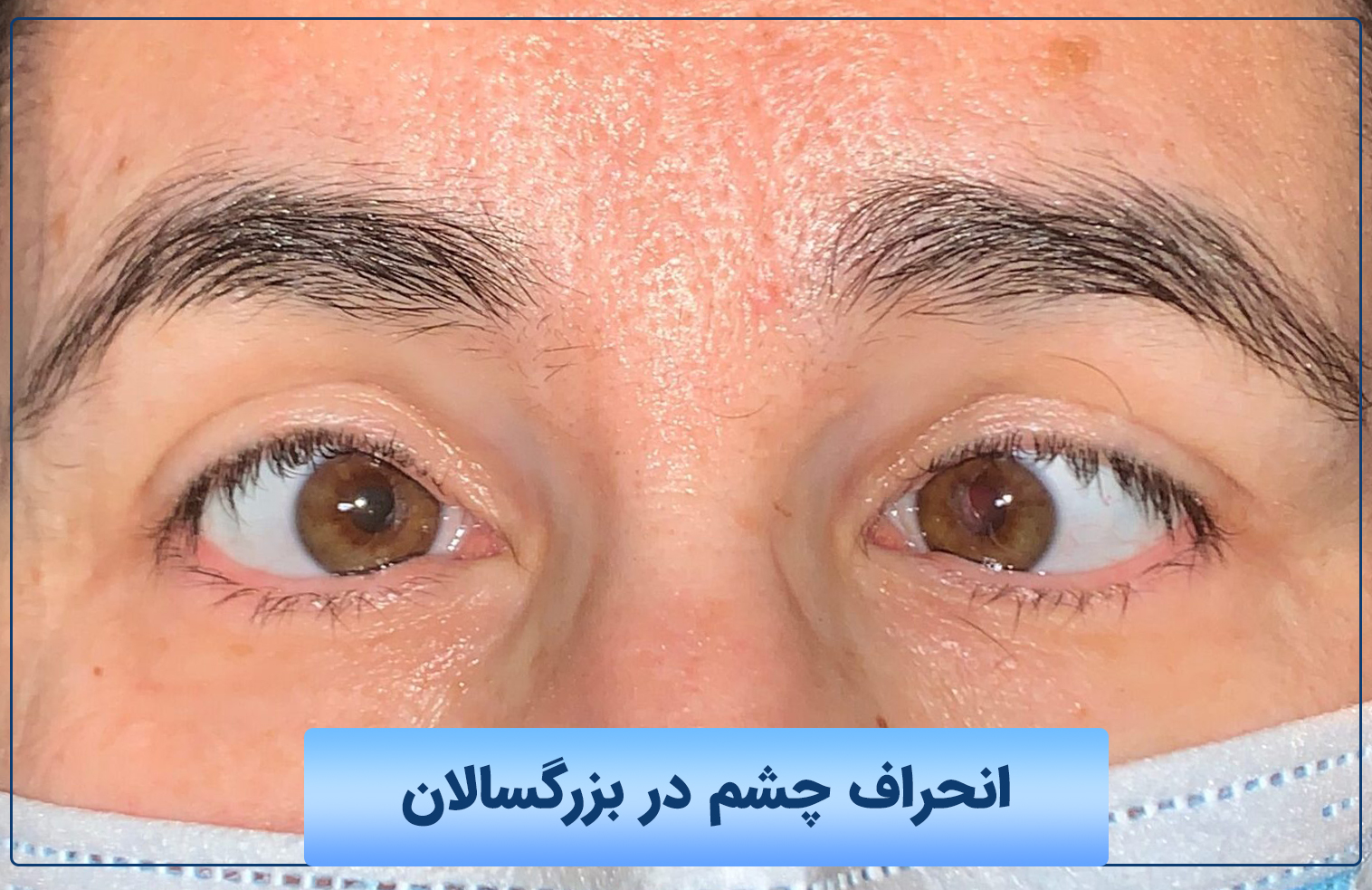 انحراف چشم در بزرگسالان