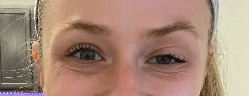 انواع پتوز چشم یا افتادگی پلک