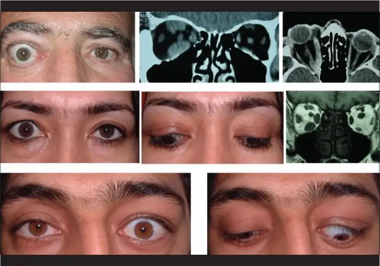 میوپاتی چشم