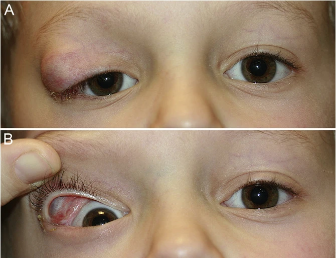 انواع کیست چشمی