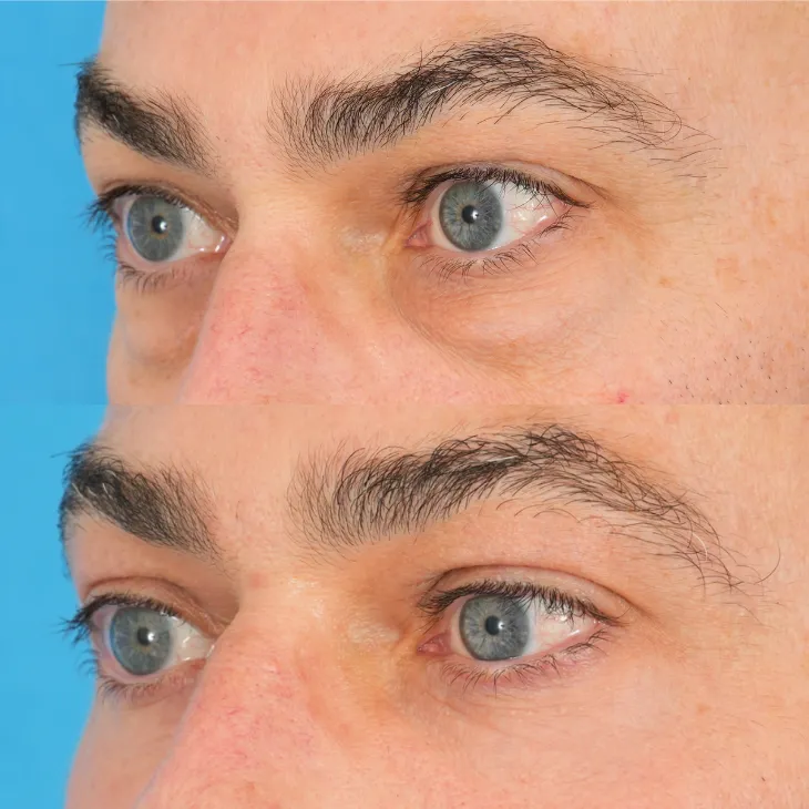 جراحی بلفاروپلاستی پلک پایین