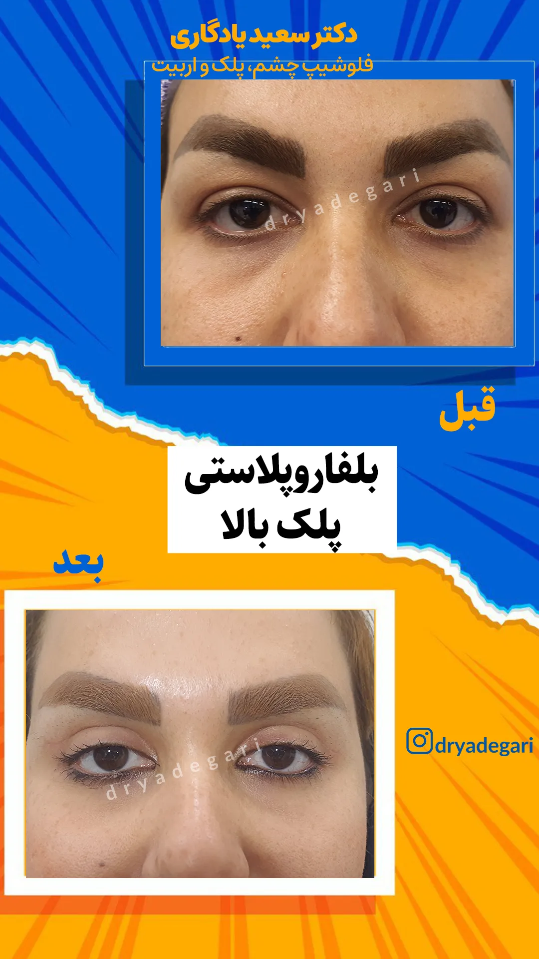 جراحی بلفاروپلاستی