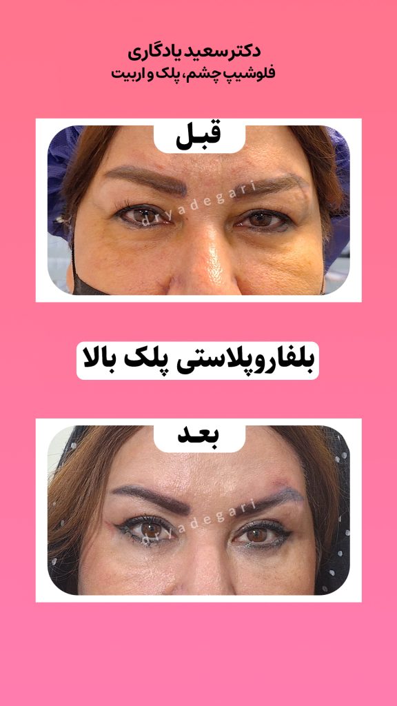 دوران نقاهت عمل بلفاروپلاستی