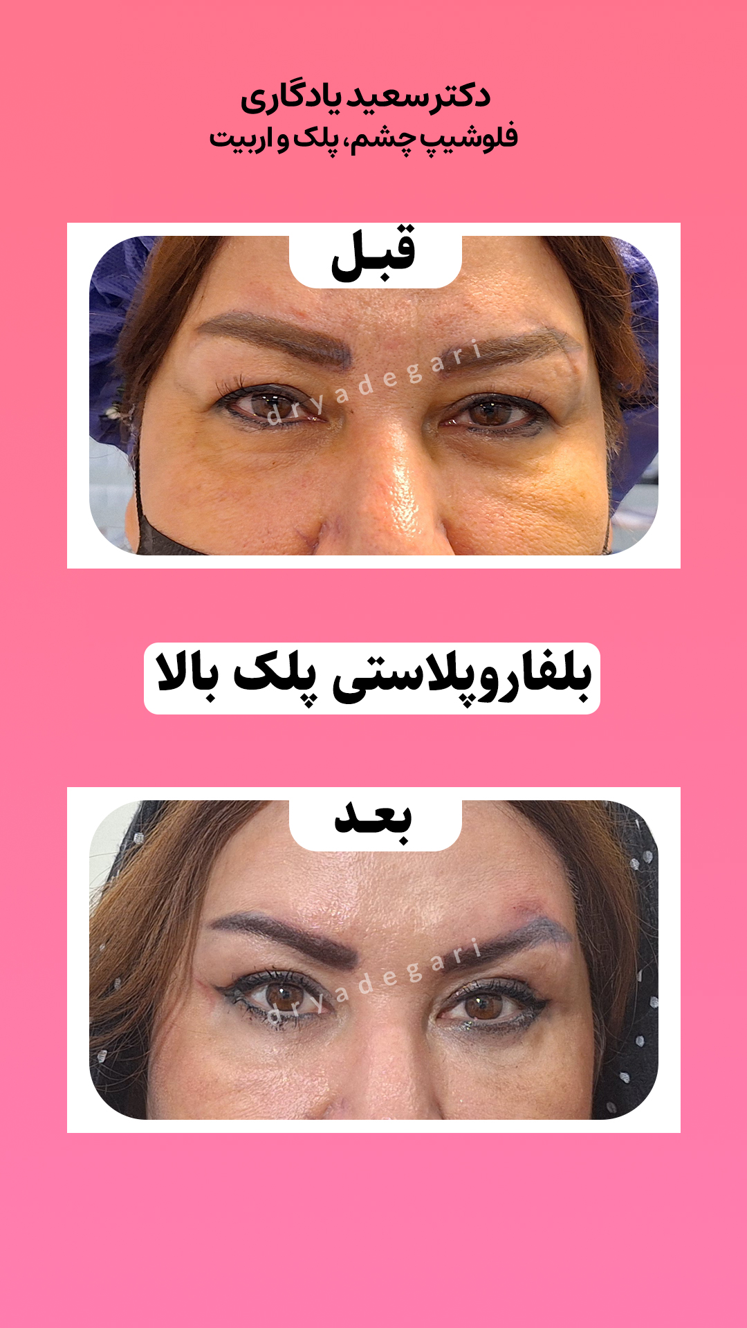 دوران نقاهت عمل بلفاروپلاستی