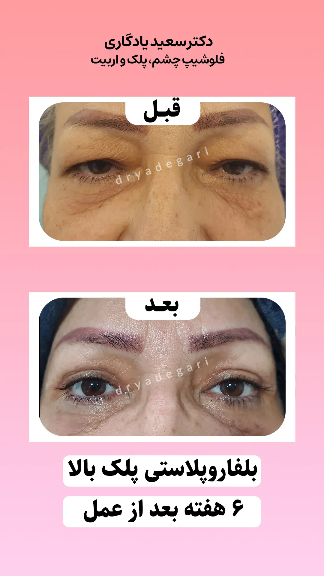 جراحی بلفاروپلاستی