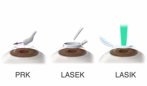 تفاوت عمل لیزیک،لازک و پی آر کی