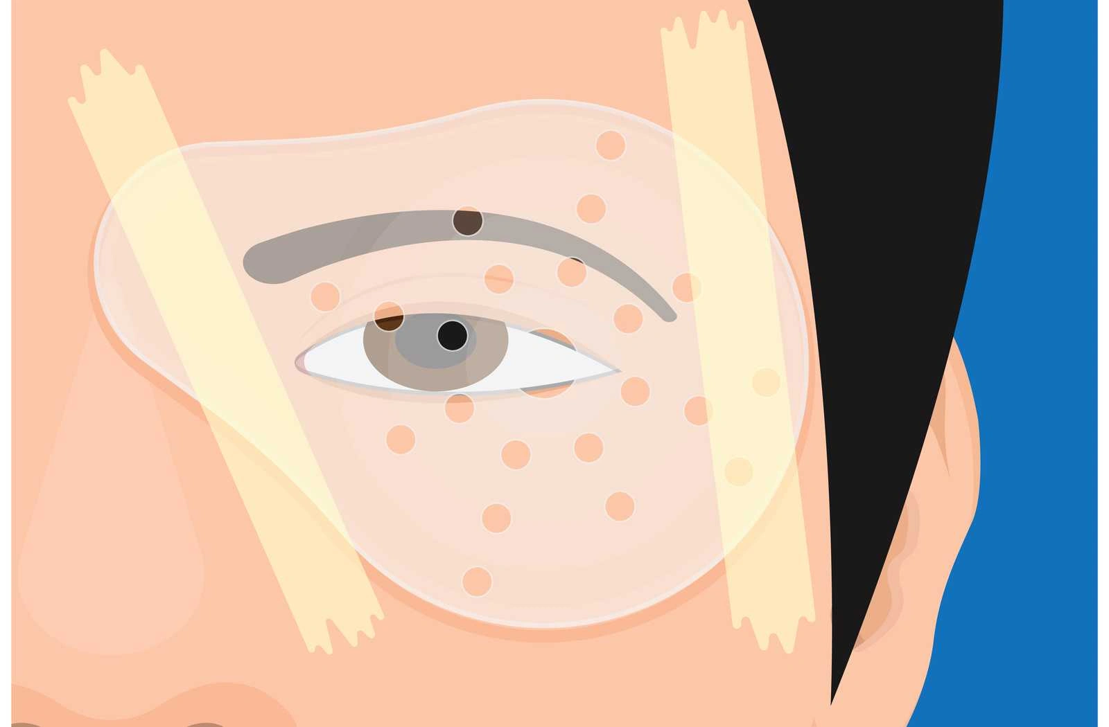 اقدامات بعد از جراحی لازک