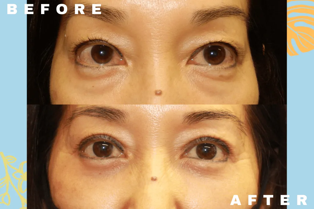 جراحی بلفاروپلاستی پلک پایین