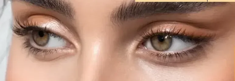 بلفاروپلاستی چشم گربه‌ای